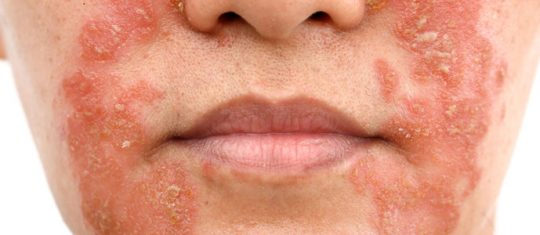 Psoriasis ou eczéma