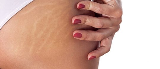 éliminer la cellulite au niveau des cuisses